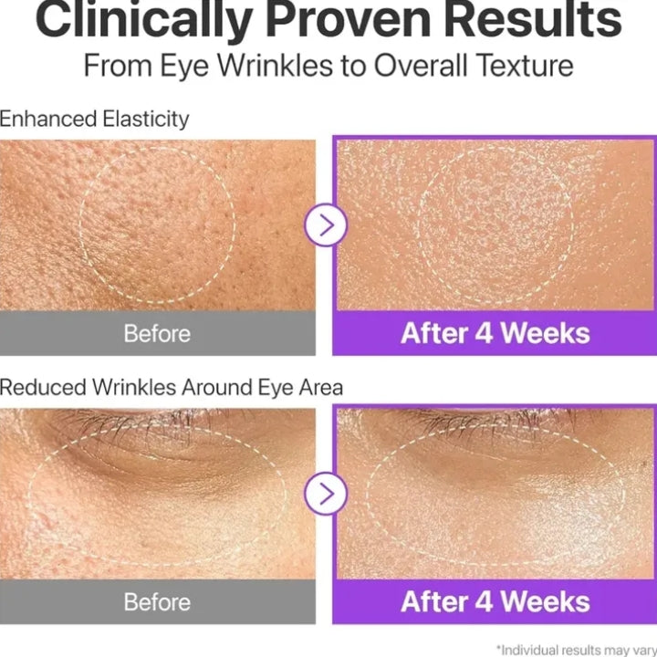 Before and after effects of a skincare product on eye wrinkles and overall texture.

